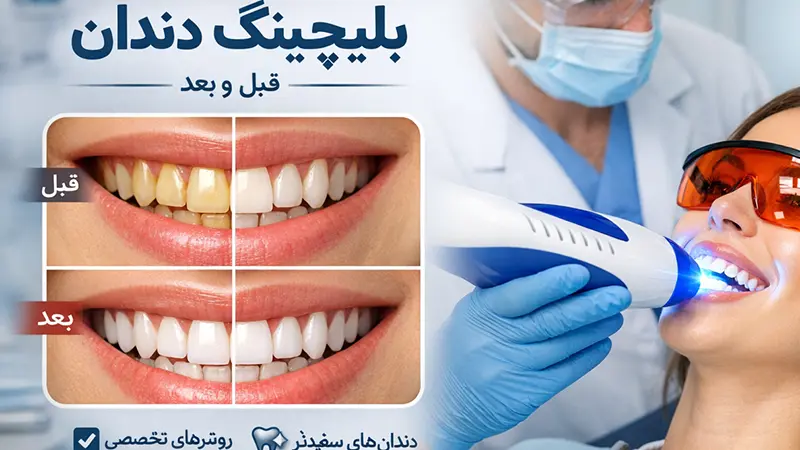 بلیچینگ چیست و چگونه باعث سفید شدن دندان می شود؟