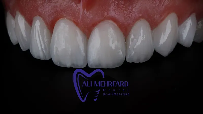 نگهداری لمینت دیجیتال