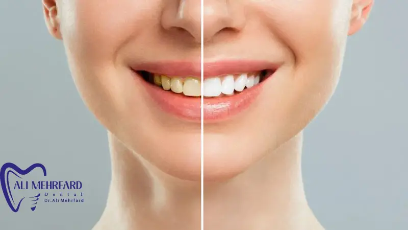 لمینت دیجیتال چیست؟ بررسی کامل مزایا، مراحل انجام، ماندگاری و تفاوت با روش های سنتی