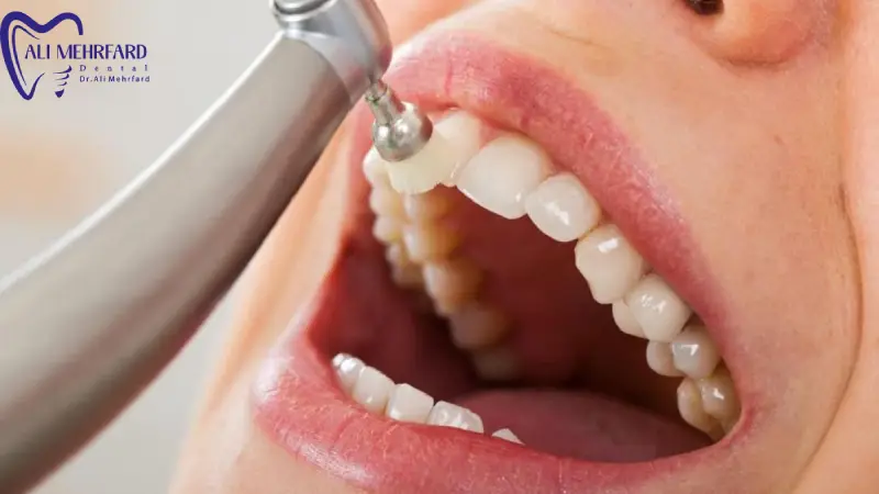 جرم دندان چیست و چگونه تشکیل می شود؟