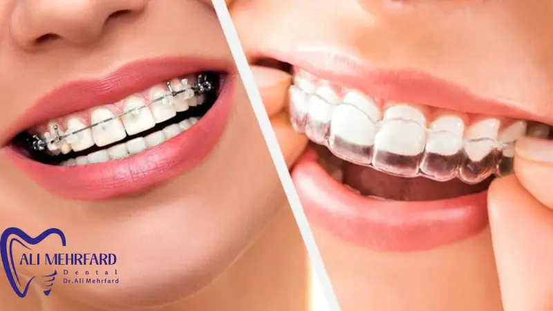ارتودنسی شفاف (اینویزیلاین) یا ارتودنسی ثابت؟ کدام انتخاب برای شما بهتر است؟