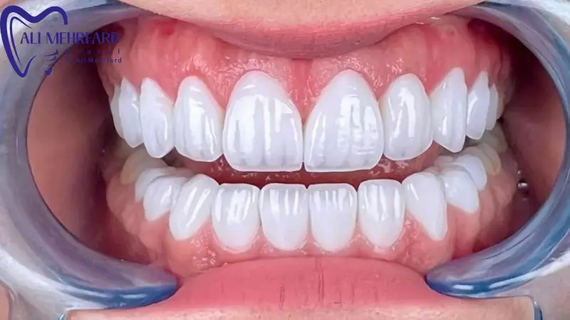 بلیچینگ در مطب یا خانگی؟ کدام روش برای سفید کردن دندان ها بهتر است؟
