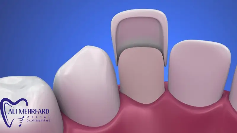 مزایا و محدودیت های لمینت بدون تراش  بررسی کامل قبل از تصمیم برای اصلاح طرح لبخند