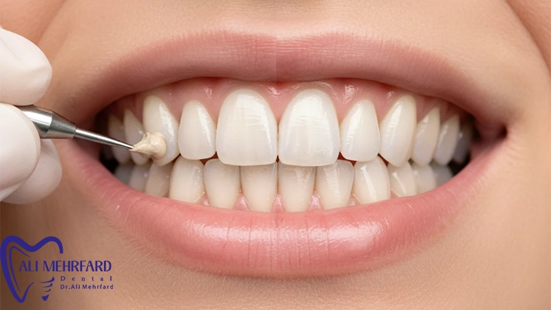 تفاوت لمینت دیجیتال و سرامیکی انتخابی هوشمند برای لبخند رویایی