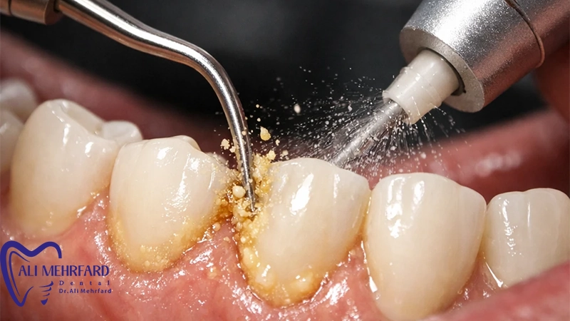 هر چند وقت یکبار جرم گیری لازم است؟