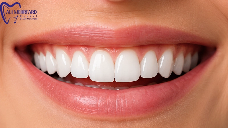 بررسی کاندید مناسب لمینت دیجیتال در کلینیک دکتر علی مهرفرد