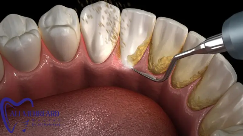 جرم گیری با دستگاه اولتراسونیک؛ راهنمای علمی و جامع برای سلامت لثه و دندان ها