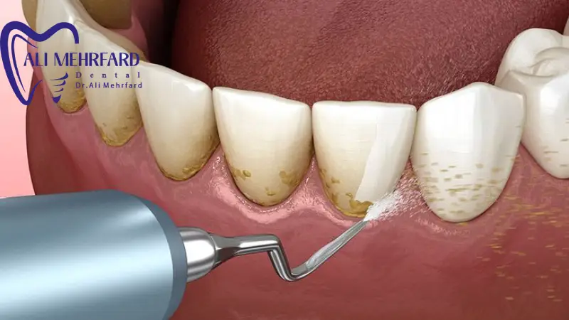 دسترسی به نواحی دشوار بین دندانی و زیر لثه در جرم گیری اولتراسونیک