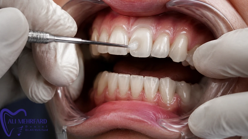 کامپوزیت دیجیتال اصولی و حفظ سلامت دندان