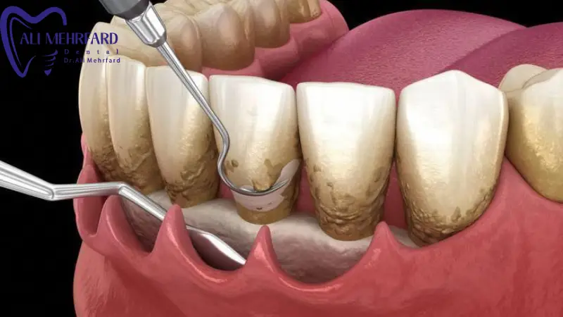 جرم گیری اولتراسونیک در کلینیک دندان پزشکی دیجیتال دکتر علی مهرفرد