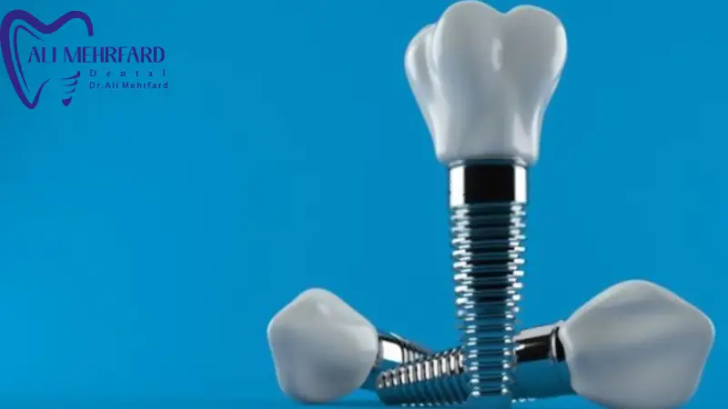 آیا برند ایمپلنت روی طول عمر آن تاثیر دارد؟
