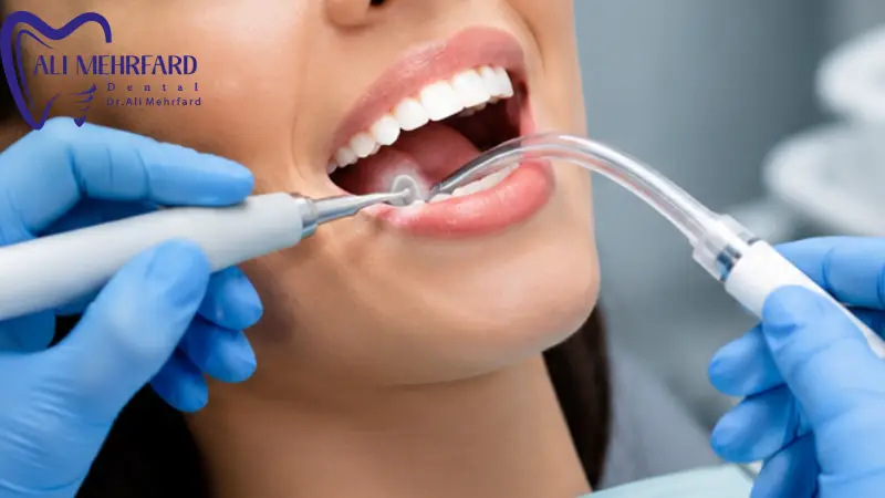 قبل از جرم گیری دندان چه نکاتی را بدانیم؟