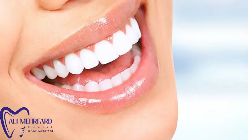 افراد دارای پوسیدگی دندان نباید بدون درمان بلیچینگ انجام دهند