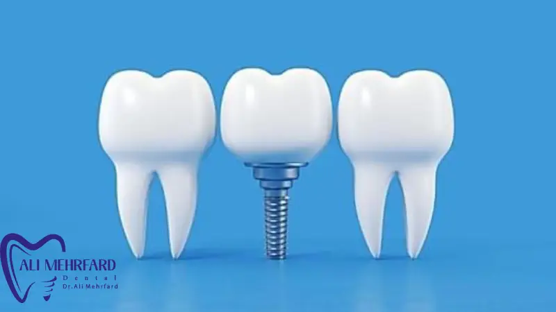 ایمپلنت دیجیتال چیست و چه تفاوتی با ایمپلنت معمولی دارد؟