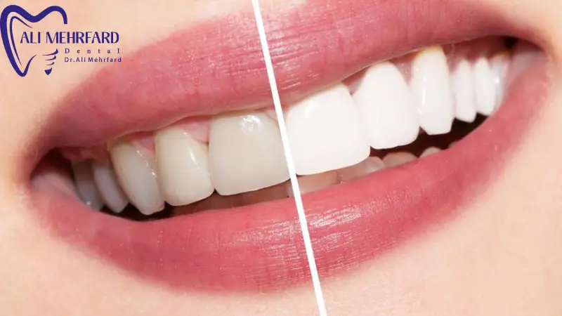 بلیچینگ برای چه سنین و شرایطی توصیه نمی شود؟