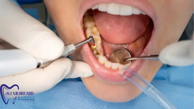 عصب کشی ارزان بهتر است یا عصب کشی با کیفیت؟