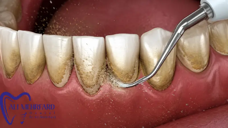 هزینه جرم گیری دندان راهنمای کامل قیمت، عوامل موثر و نکات قبل از درمان