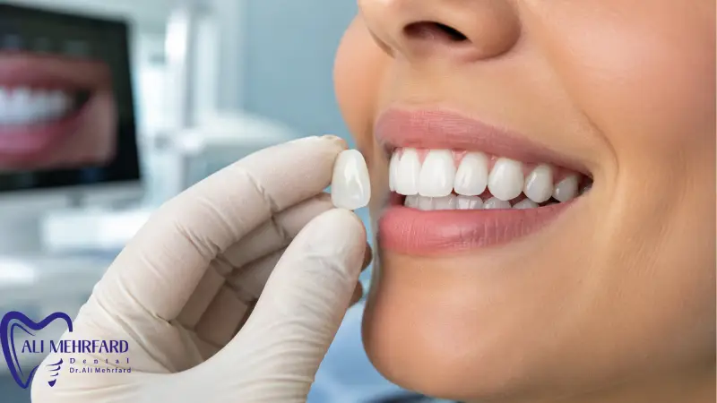 کامپوزیت دیجیتال یا لمینت؟ | مقایسه مزایا و ماندگاری 5 سوالات متداول درباره کامپوزیت دیجیتال یا لمینت