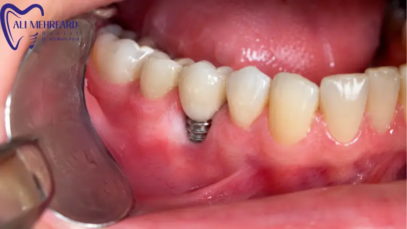 چگونه هزینه ایمپلنت دیجیتال را منطقی مدیریت کنیم؟